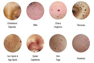 Benefits of Lamprobe for Skin Treatments Benefits of Lamprobe for Skin Treatments