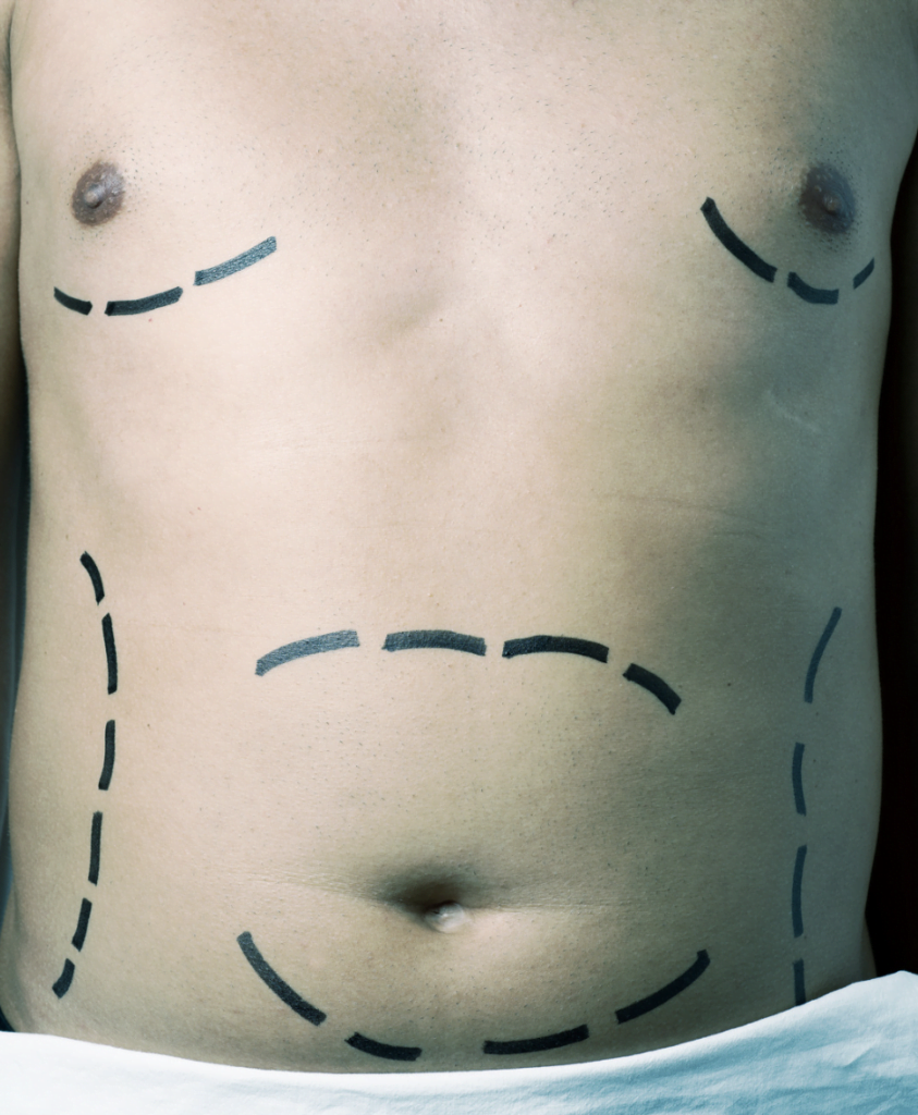 Bronx Plastic Surgery: Sculpting the Body Youve Always Wanted