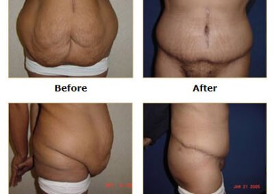 Bronx Plastic Surgery: Sculpting the Body Youve Always Wanted