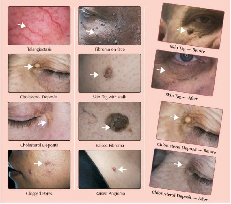 Common Skin Conditions Treated with Lamprobe