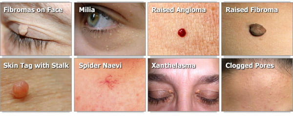 Common Skin Conditions Treated with Lamprobe