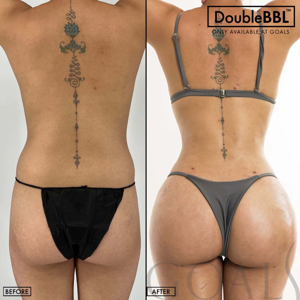 Elevating Your Confidence: Atlanta Goals Plastic Surgery Elevating Your Confidence: Atlanta Goals Plastic Surgery