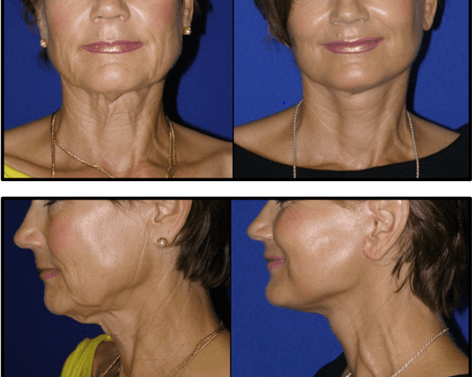 Elevating Your Self-Image through Plastic Surgery in Maryland