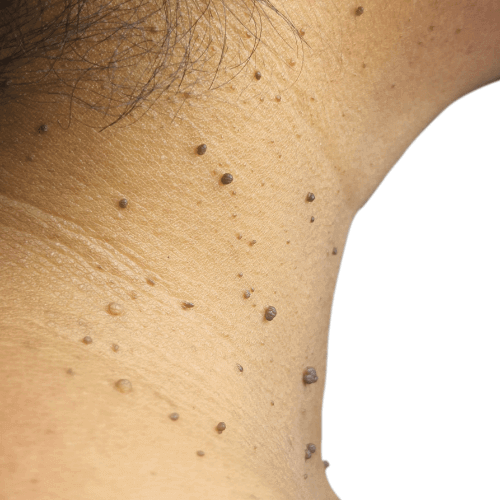 How Lamprobe Can Remove Skin Tags How Lamprobe Can Remove Skin Tags