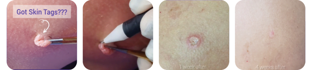 How Lamprobe Can Remove Skin Tags How Lamprobe Can Remove Skin Tags