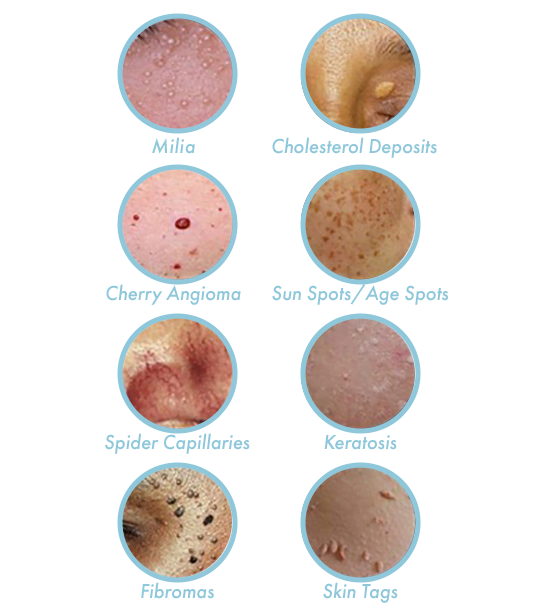 Lamprobe: A Non-Invasive Solution for Sunspots