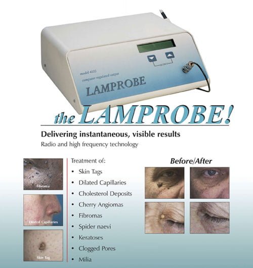 Lamprobe for Effective Removal of Milia