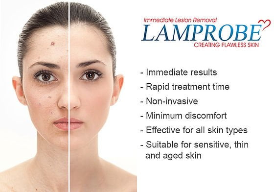 Lamprobe for Rapid Removal of Fibromas