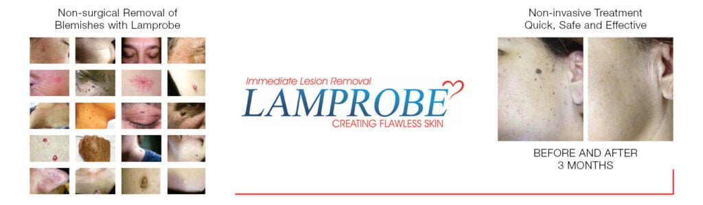 Lamprobe for Safe and Painless Removal of Cherry Angiomas