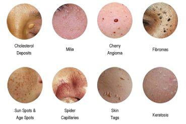 Lamprobe vs. Other Skin Resurfacing Techniques