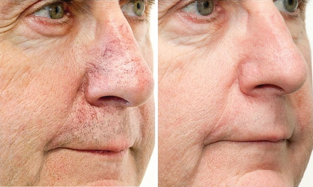 The Role of Lamprobe in Treating Broken Capillaries The Role of Lamprobe in Treating Broken Capillaries