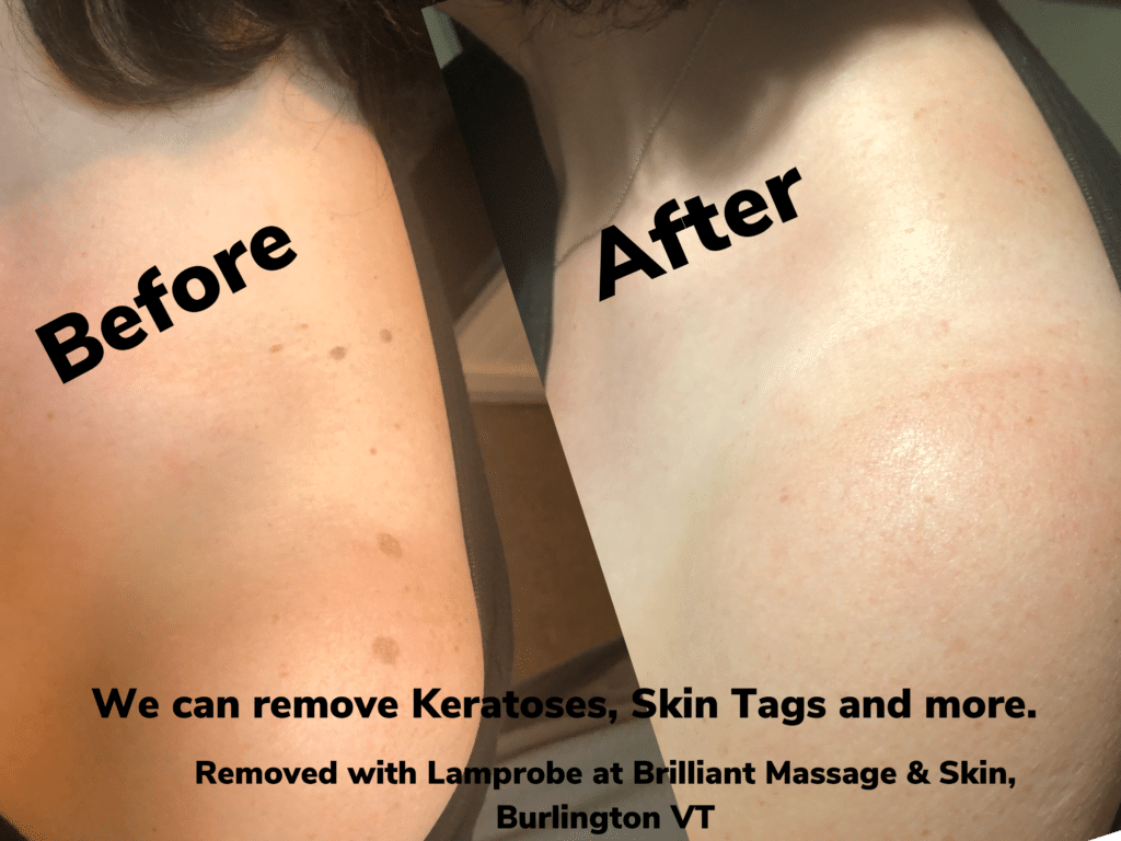 The Role of Lamprobe in Treating Broken Capillaries The Role of Lamprobe in Treating Broken Capillaries