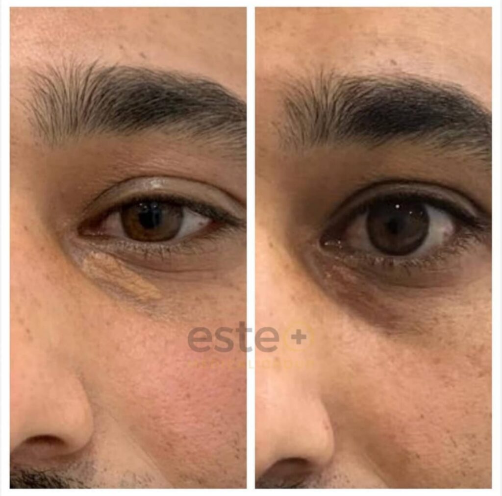 Understanding the Versatility of Lamprobe in Skin Aesthetics Understanding the Versatility of Lamprobe in Skin Aesthetics