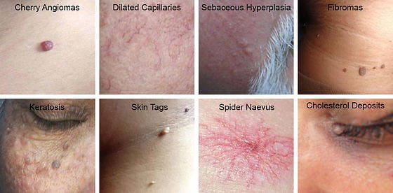 Why Lamprobe Is an Ideal Treatment for Sebaceous Hyperplasia