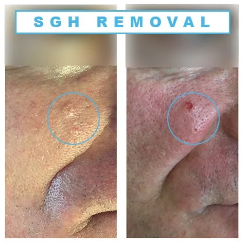 Why Lamprobe Is an Ideal Treatment for Sebaceous Hyperplasia