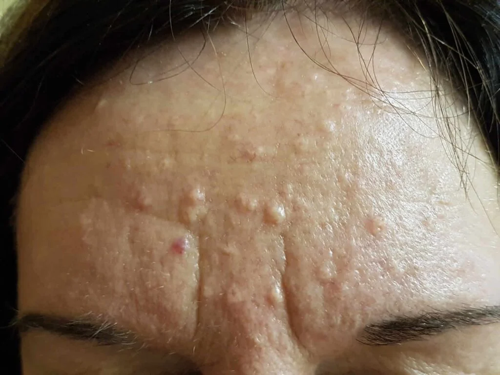 Why Lamprobe Is an Ideal Treatment for Sebaceous Hyperplasia